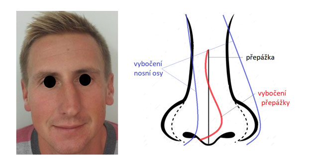 Deformace nosu